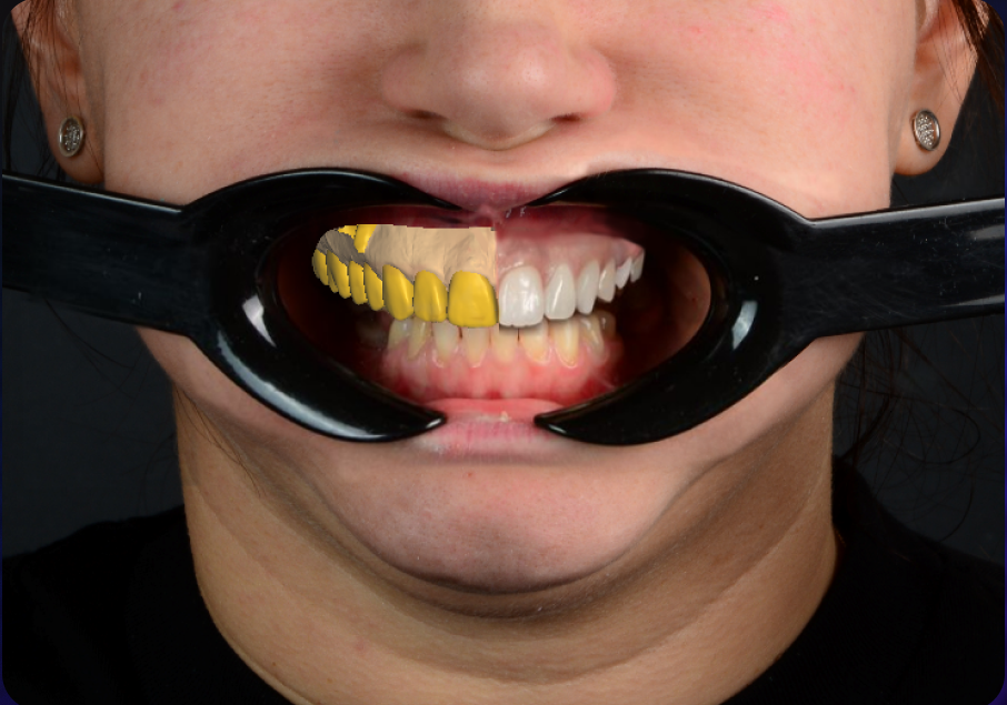  Демонстрационный курс: от идеи к цифровому результату с Exocad и Smilecloud